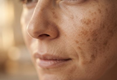 Pigmentation Treatment_img