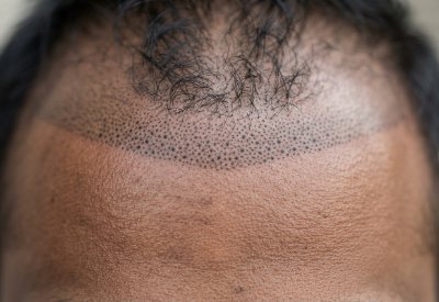 Scalp Micropigmentation_img
